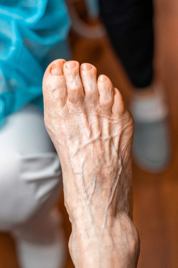 Close-up,Of,An,Elderly,Foot,With,Deformed,Toes,,Thickened,,Discolored