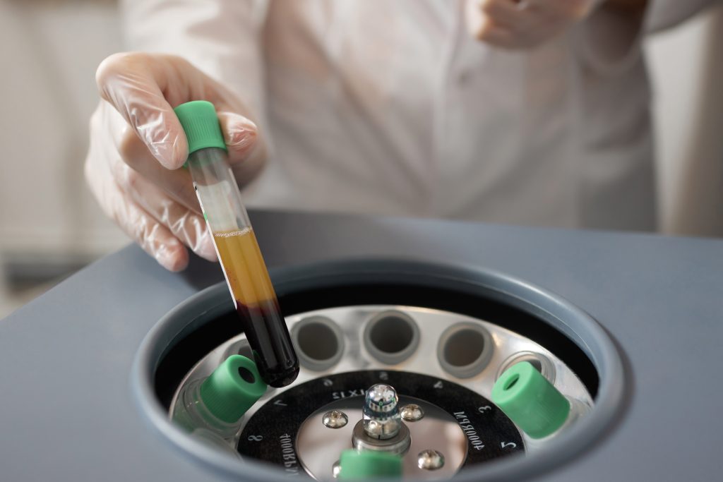 Platelet-rich,Plasma,Preparation.,Plasma,In,Syringe.,Centrifuge.